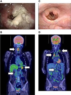 Systemic Epstein–Barr Virus-Positive T/NK Lymphoproliferative Diseases With SH2D1A/XIAP Hypomorphic Gene Variants